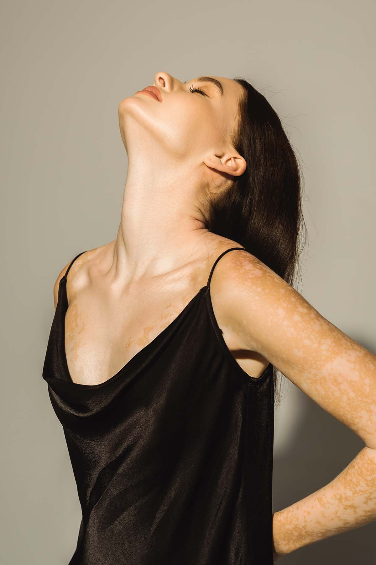 Model with Vitiligo